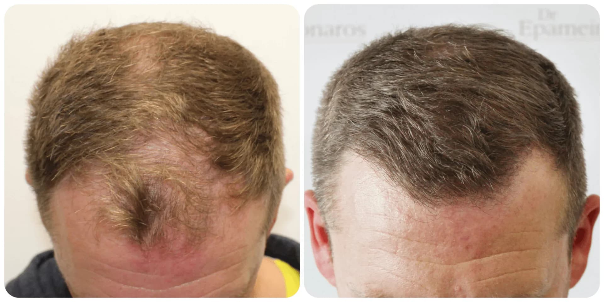 Hair Transplant UK – How We Deliver Natural, Permanent Results