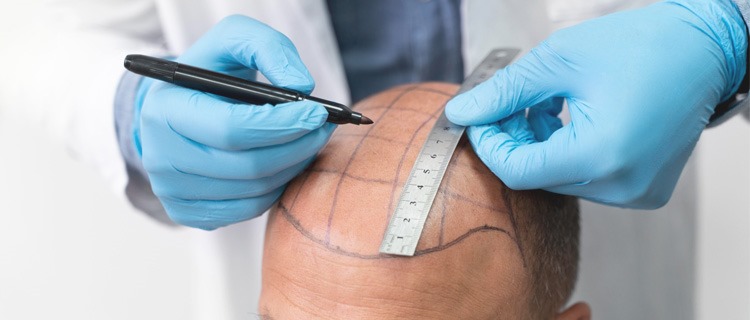 Hair Transplant – FUE vs FUT: Which Is Right for You?