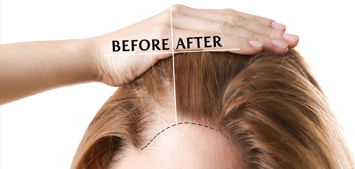Hair Transplant Istanbul: Top Reasons to Choose Turkey’s Hub