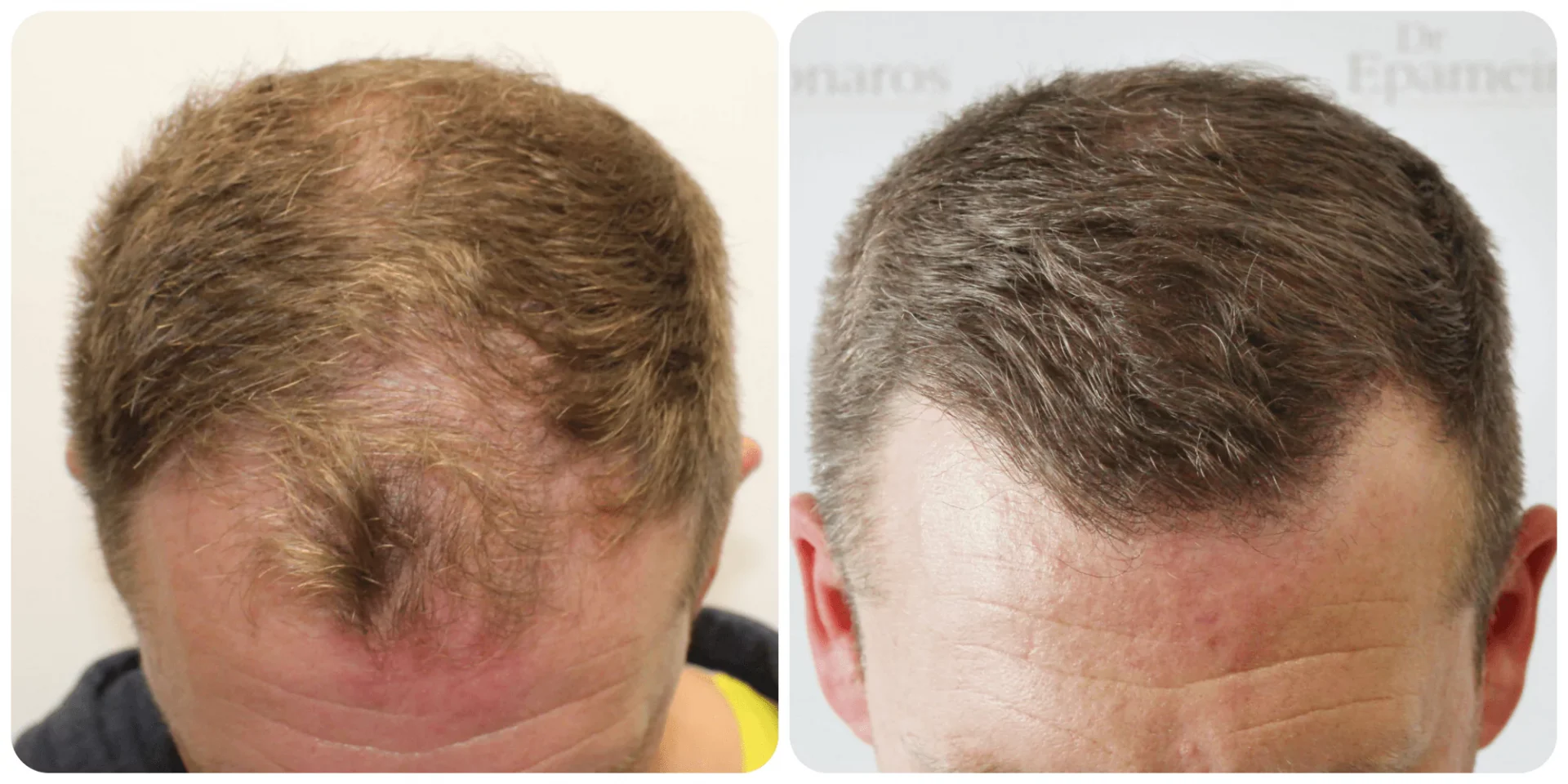 Hair Transplant UK – How We Deliver Natural, Permanent Results
